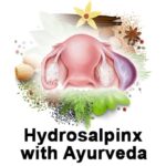 Ayurvedic Treatment For Infertility Due To Hydrosalpinx – Dr. Chanchal Sharma.